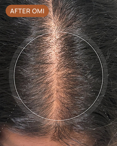 Mary S's hairline after using OMI