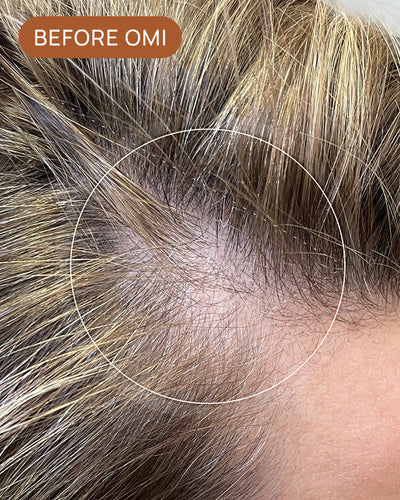Caroline L's hairline before using OMI