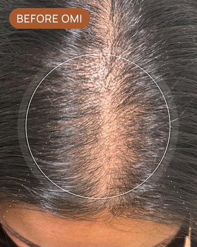 Mary S's hairline before using OMI