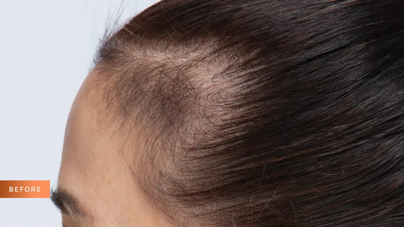 Close-up of a person's head with hair loss on a light blue background