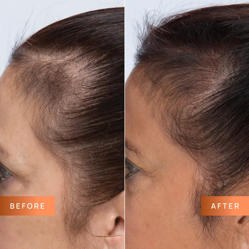 Before and after comparison of hair growth on a person's head.