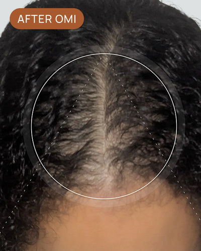 Cara P's hairline after using OMI