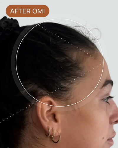 Isabella A's hairline after using OMI
