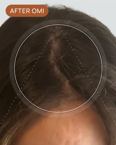 Ondrea D's hairline after using OMI