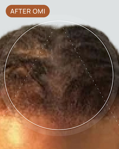 Akila C's hairline after using OMI
