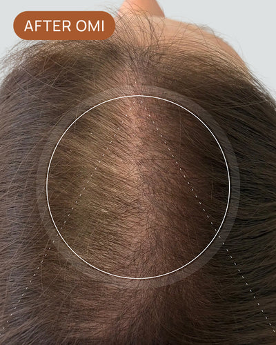Beckie K's hairline after using OMI