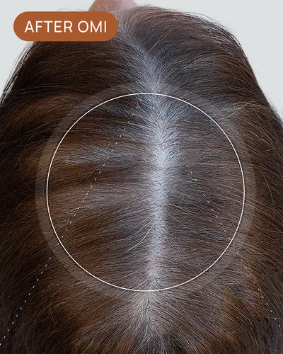 MIA Z's hairline after using OMI