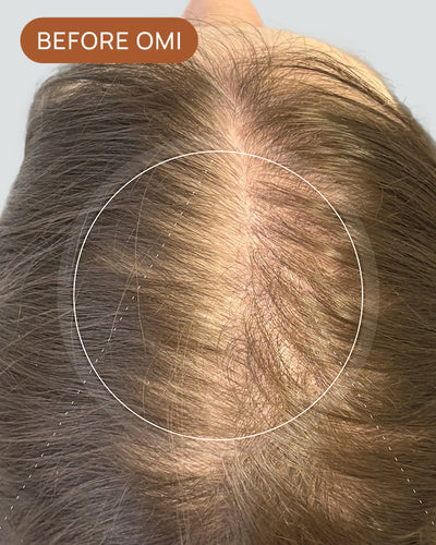 Beckie K's hairline before using OMI