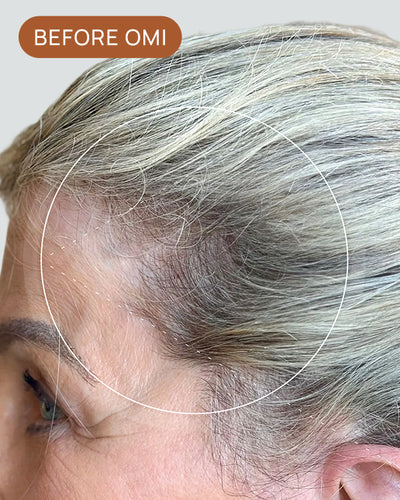 Rachelle B's hairline before using OMI