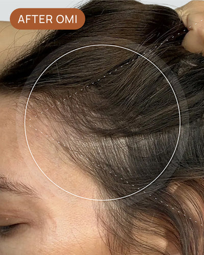 Darcy S's hairline after using OMI