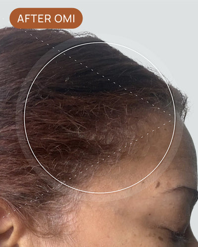 Tina L's hairline after using OMI