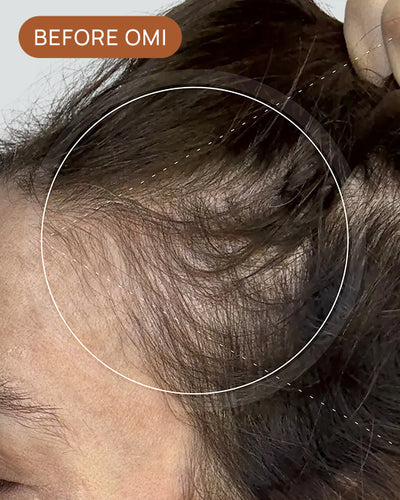 Darcy S's hairline before using OMI