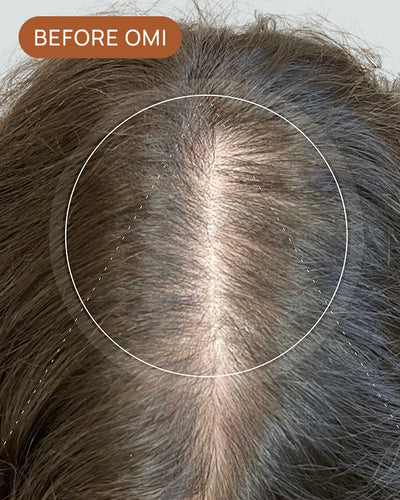 Diana C's hairline before using OMI