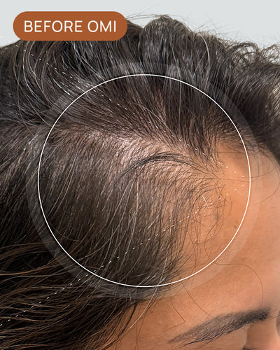 Pholla S's hairline before using OMI