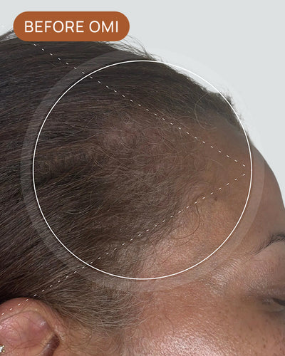 Tina L's hairline before using OMI