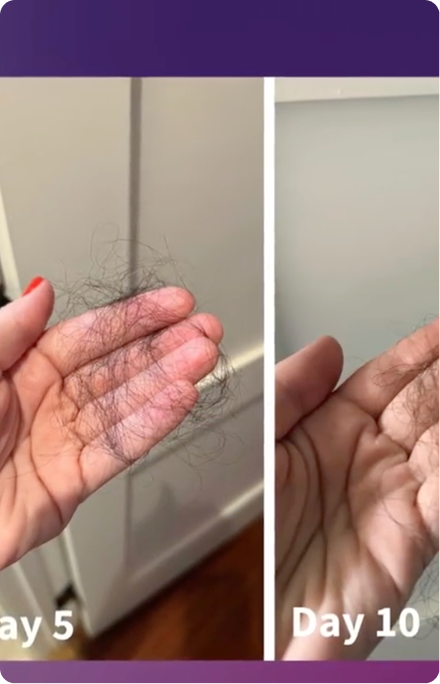 Hair loss