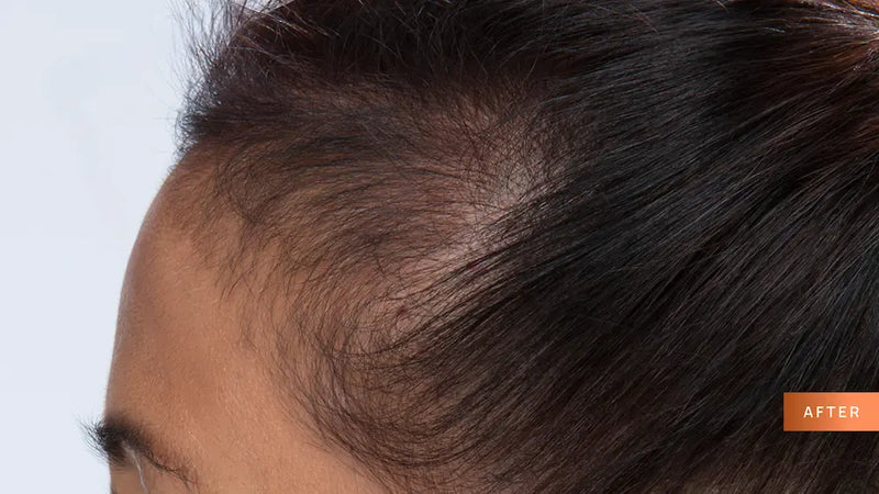 Close-up of a person's head with hair growth after treatment on a light gray background