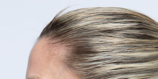 Is Your Hairline Thinning? How to Pick the Right Treatment Plan