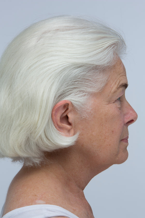 3 MONTHS SCALP COVERAGE