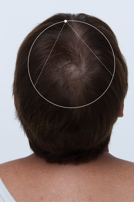 3 MONTHS SCALP COVERAGE