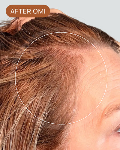 Allison L's hairline after using OMI
