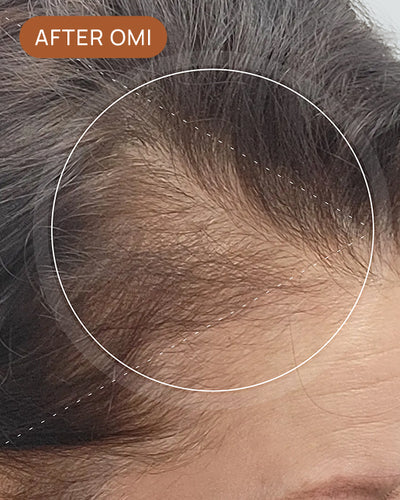 Debra L's hairline after using OMI