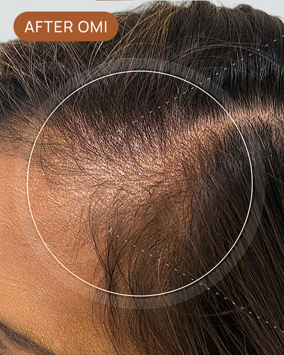 Veronica G's hairline after using OMI