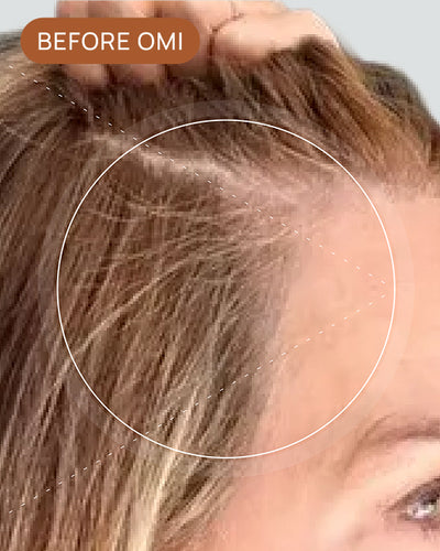 Allison L's hairline before using OMI