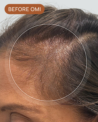 Veronica G's hairline before using OMI