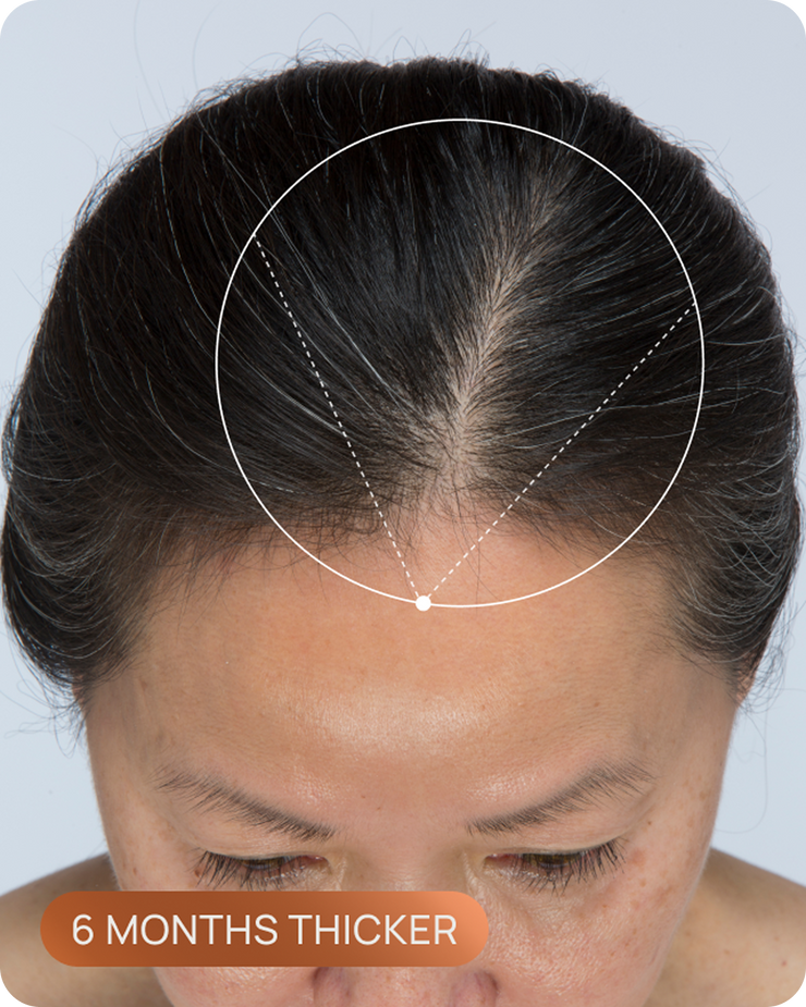 Tracy's hairline after OMI, with visibly denser hair through the part