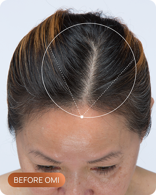 Tracy's hairline before OMI, showing thinning through the part