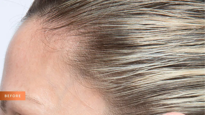 Close-up of a person's head with hair showing signs of thinning, labeled 'Before' on a white background.