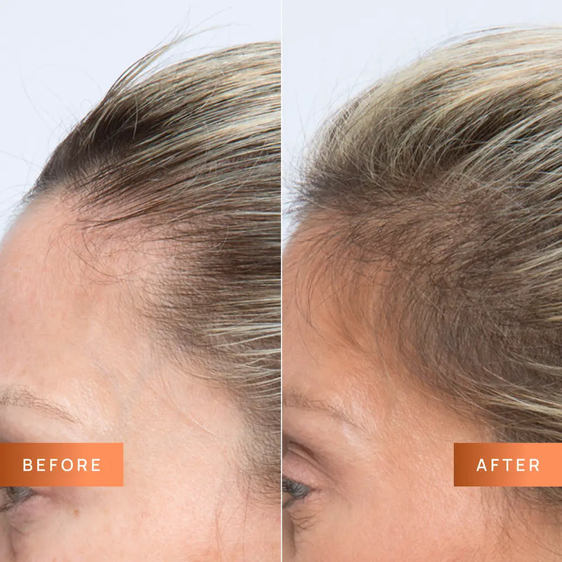 Before and after comparison of hair density on a person's head.