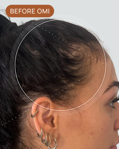 Isabella A's hairline before using OMI