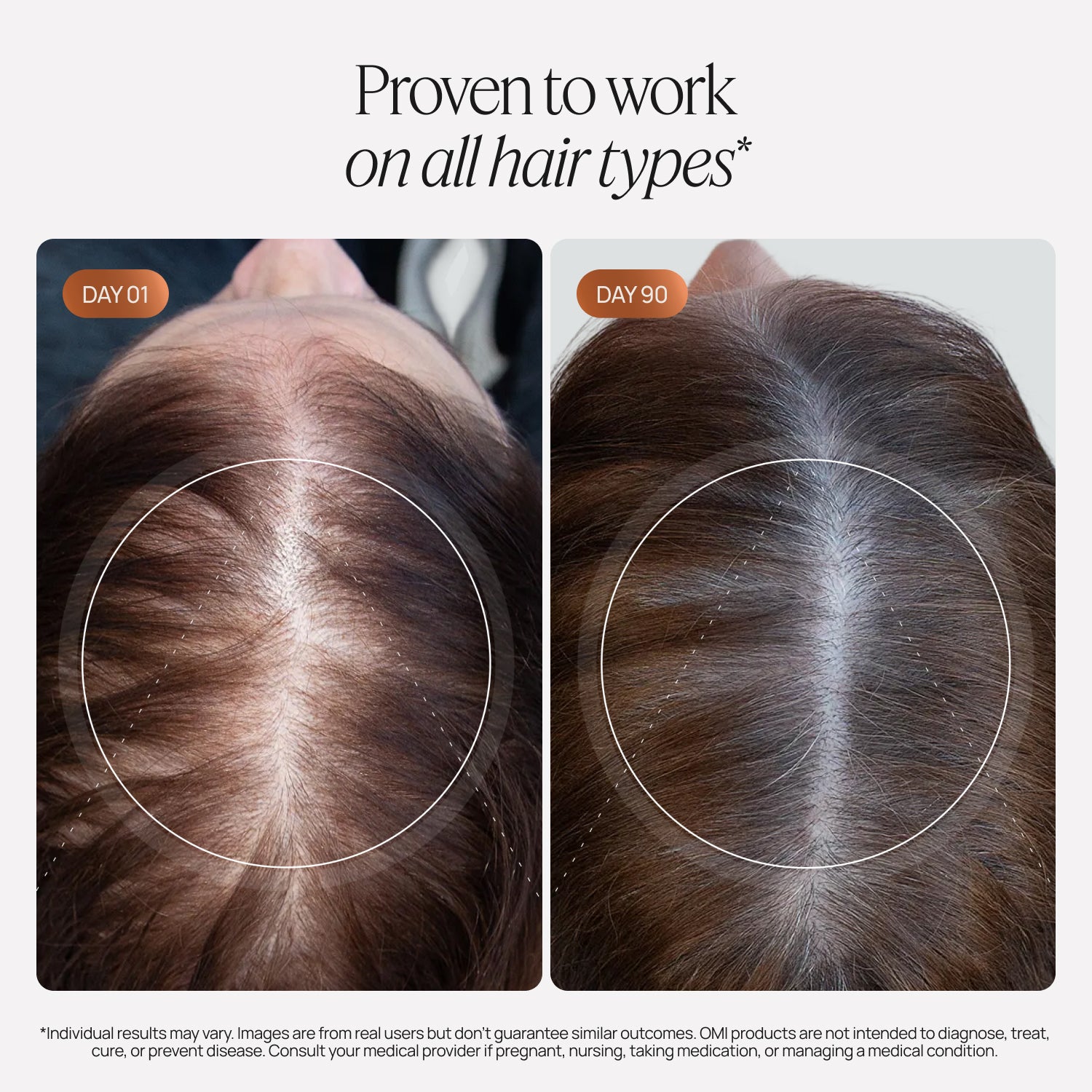 Before and after comparison of hair growth on a person's scalp, showing visible improvement over 90 days.