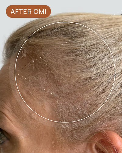 Deb D's hairline after using OMI