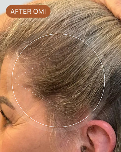 Rachelle B's hairline after using OMI
