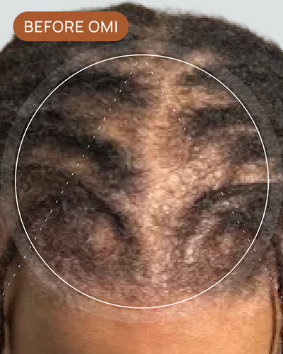 Akila C's hairline before using OMI