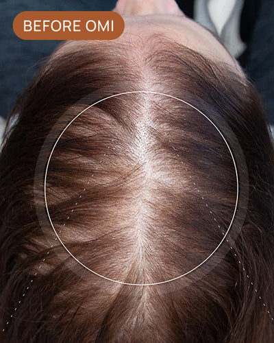 MIA Z's hairline before using OMI