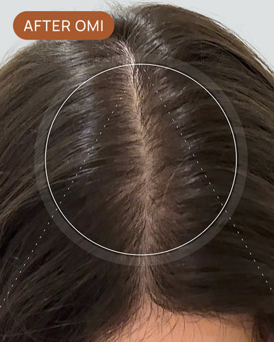 Diana C's hairline after using OMI