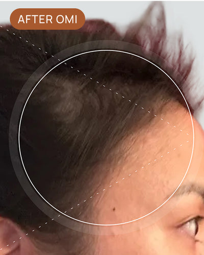 Laura T's hairline after using OMI