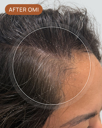 Pholla S's hairline after using OMI