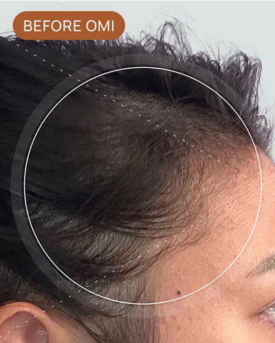 Laura T's hairline before using OMI