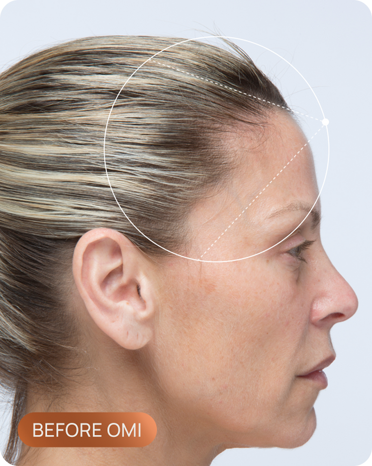 Tracy's hairline before OMI, showing thinning through the part