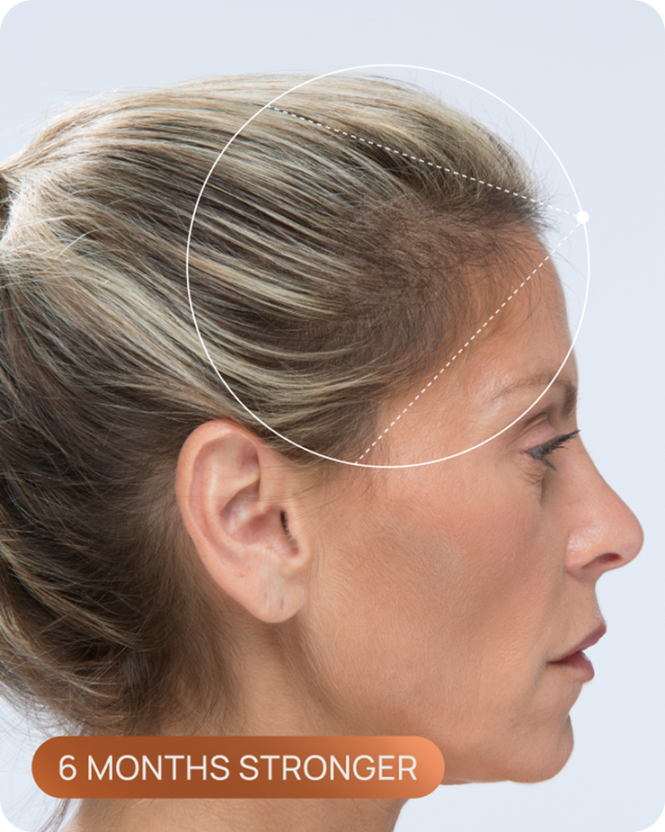 Tracy's hairline after OMI, with visibly denser hair through the part