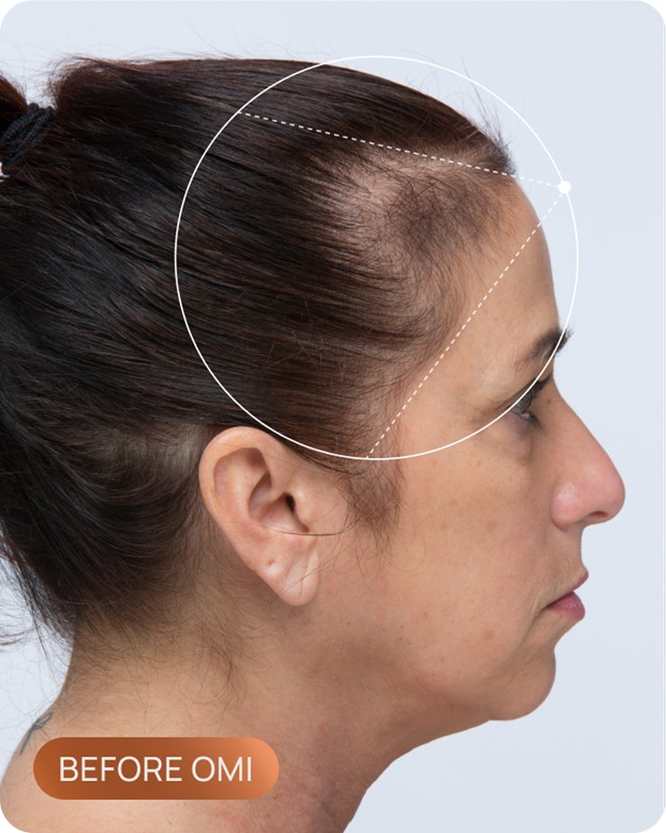 Tracy's hairline before OMI, showing thinning through the part