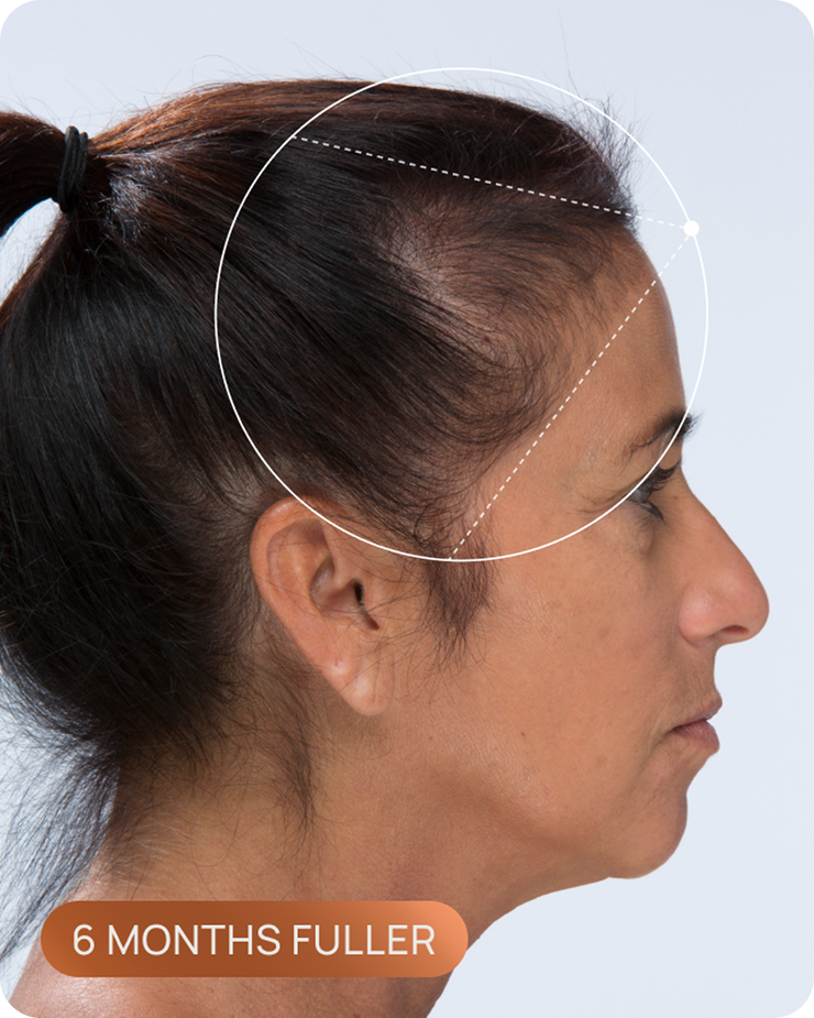Tracy's hairline after OMI, with visibly denser hair through the part