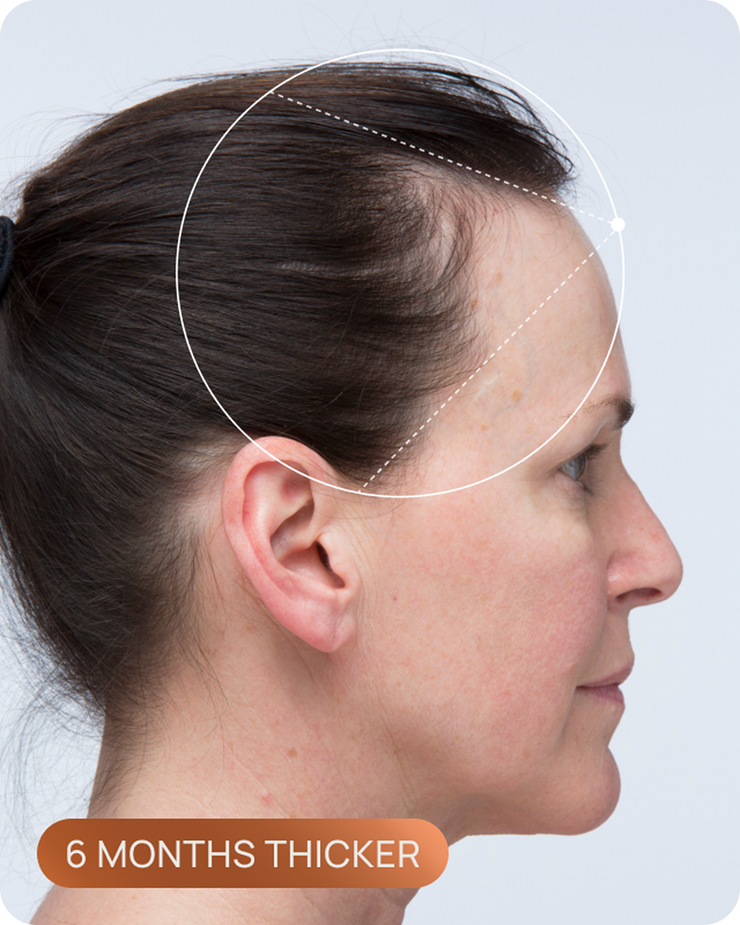 Tracy's hairline before OMI, showing thinning through the part